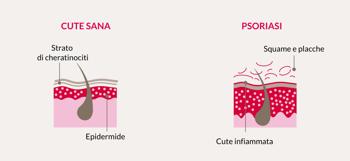 Diagramma mostra differenza tra cute sana e infiammata