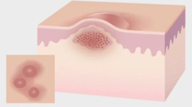 Sintomi idrosadenite suppurativa o acne inversa | La pelle conta