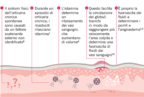 cause e sintomi dell'orticaria cronica spontanea