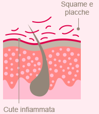 cute con psoriasi