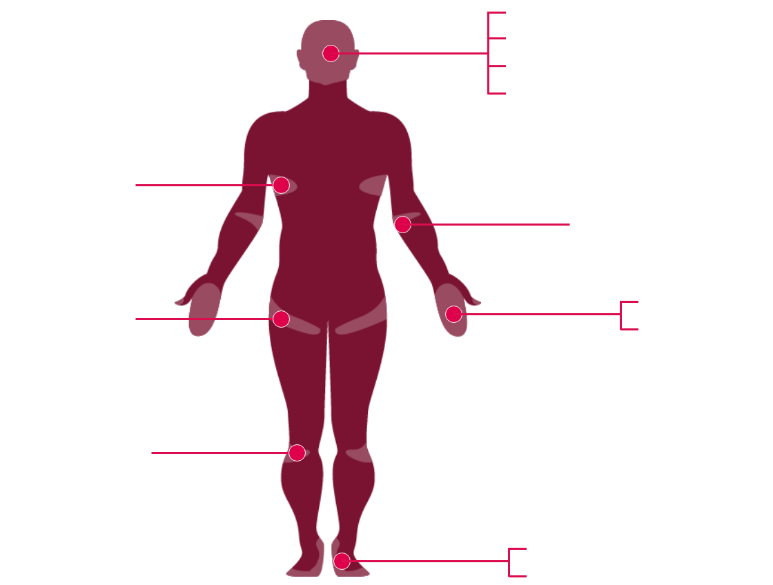 Aree del corpo interessate dalla psoriasi